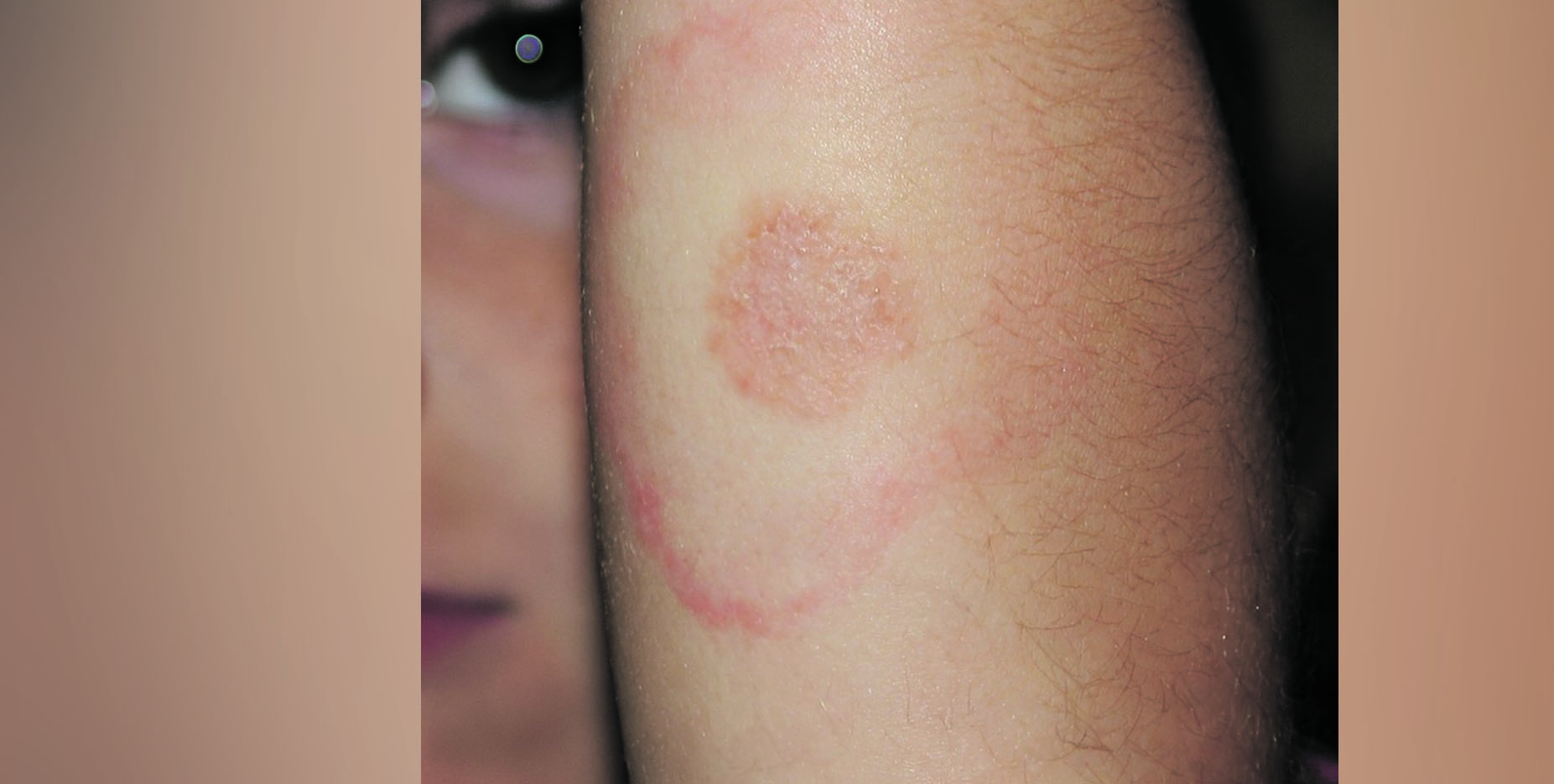 Health: Call for Lyme disease awareness as warmer weather draws people outdoors