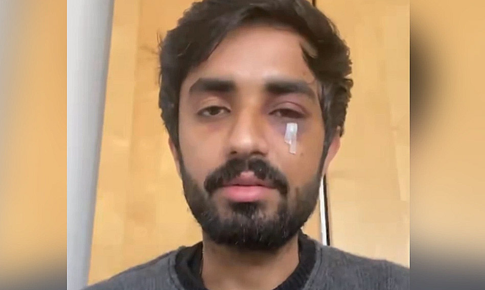 Pakistani student suffers facial fractures in alleged racist attack in Glasgow