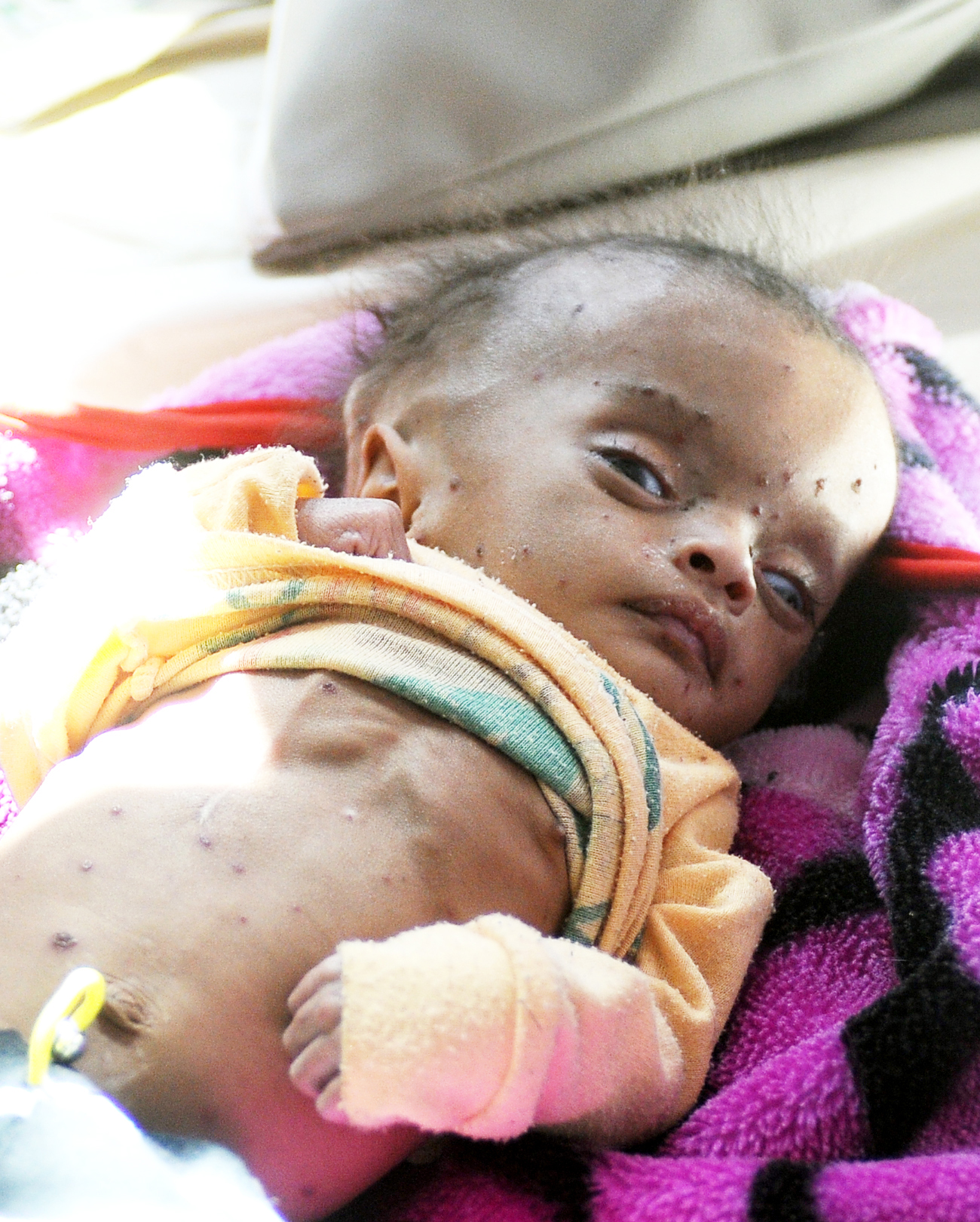 Yemen facing the worst famine in 100 years