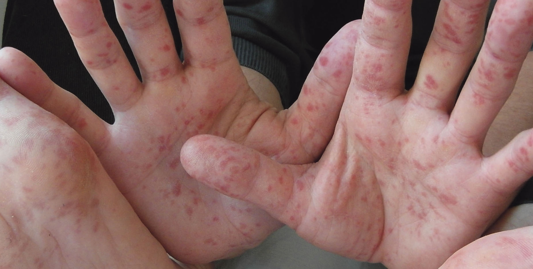 Health: Rise in cases of Hand, Foot and Mouth Disease in children