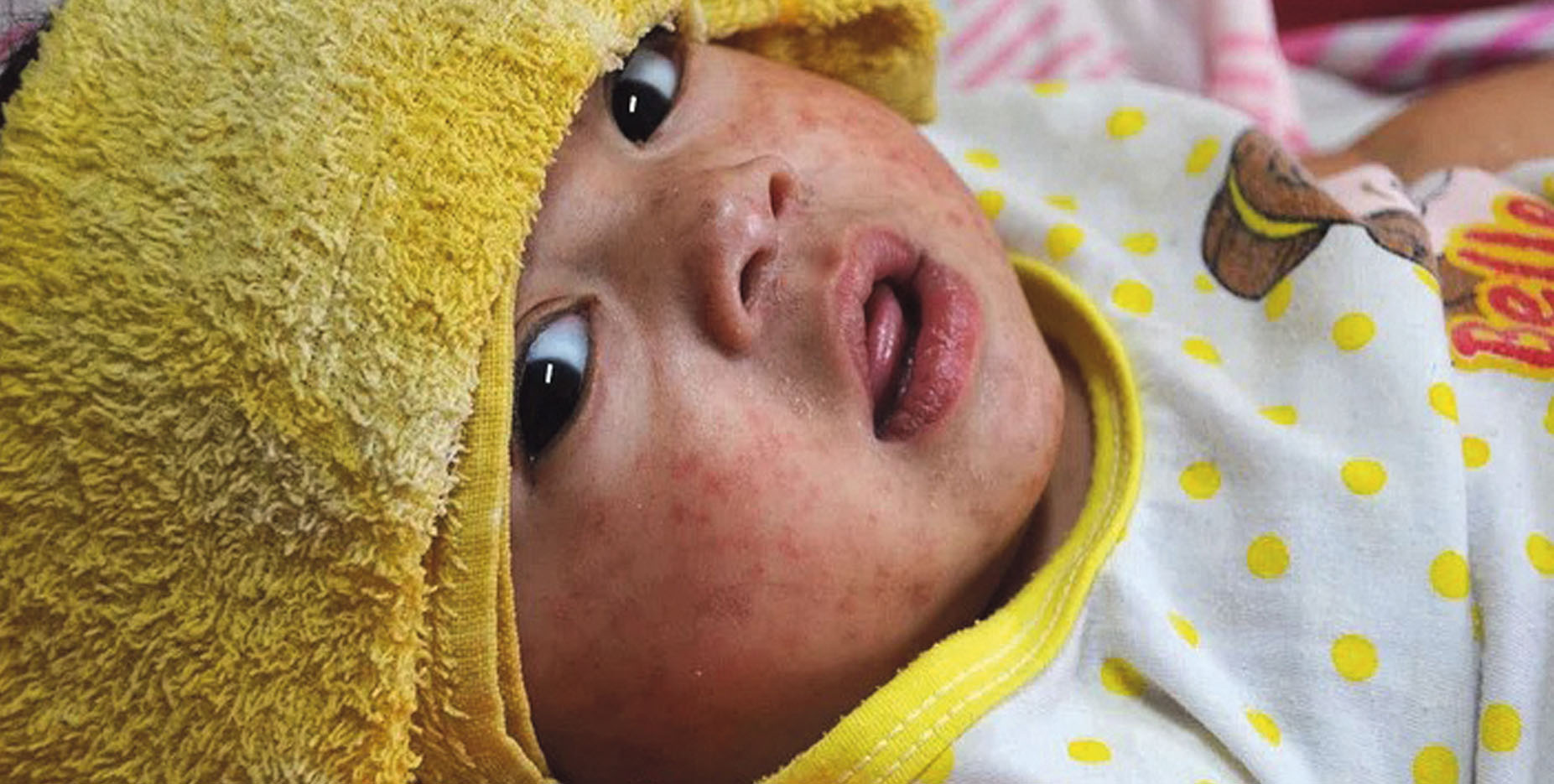 Health: Rise in measles cases in England as MMR vaccine rate falls
