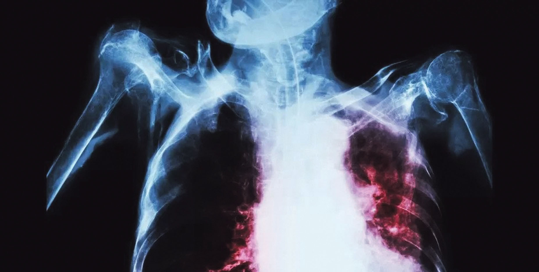 Heath & Science: Shorter treatment time for TB proven safe and effective